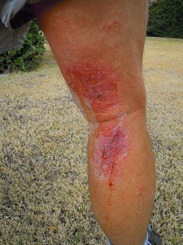 poison oak rash treatment. Calf Rash