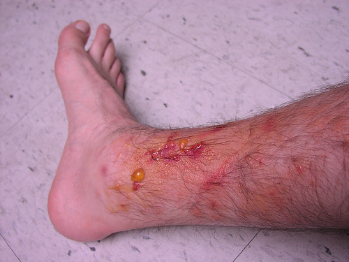 what does poison sumac rash look like. Leg Rash